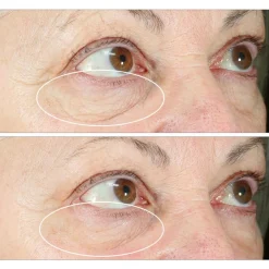 Strivectin Hyperlift Eye Instant Eye Fix 10ml Tighten & Lift  Oogcreme